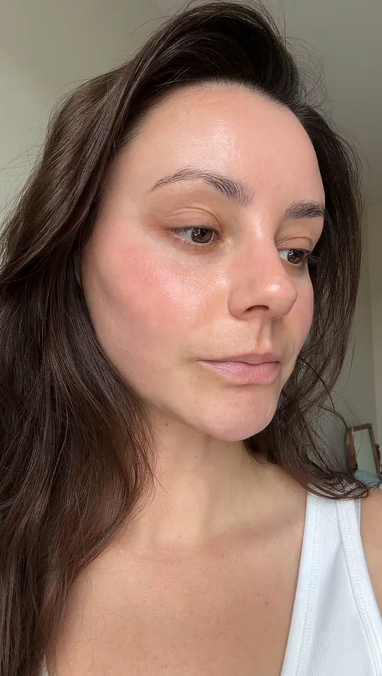Too Much of a Good Thing: Beauty Editors and the Risk of Perioral Dermatitis
