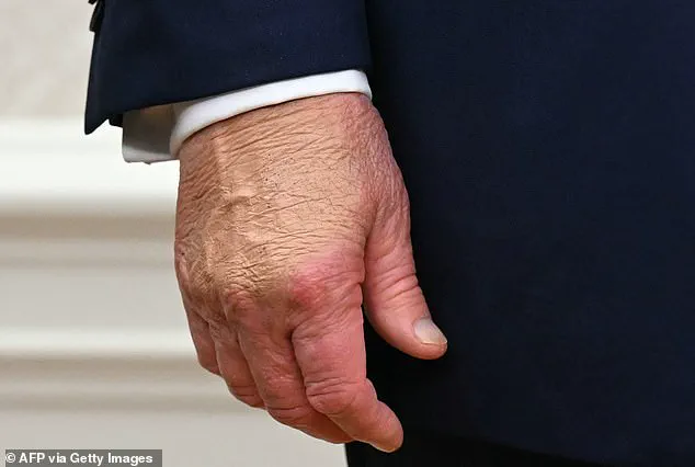 President Trump Sustains Hand Bruise During Davos Event, Says White House