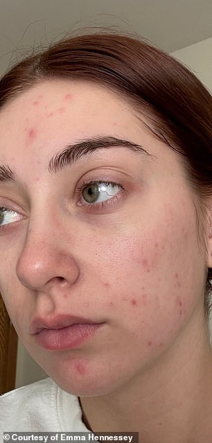 Celebrities praise isotretinoin microdosing for anti-aging, but hidden dangers remain.
